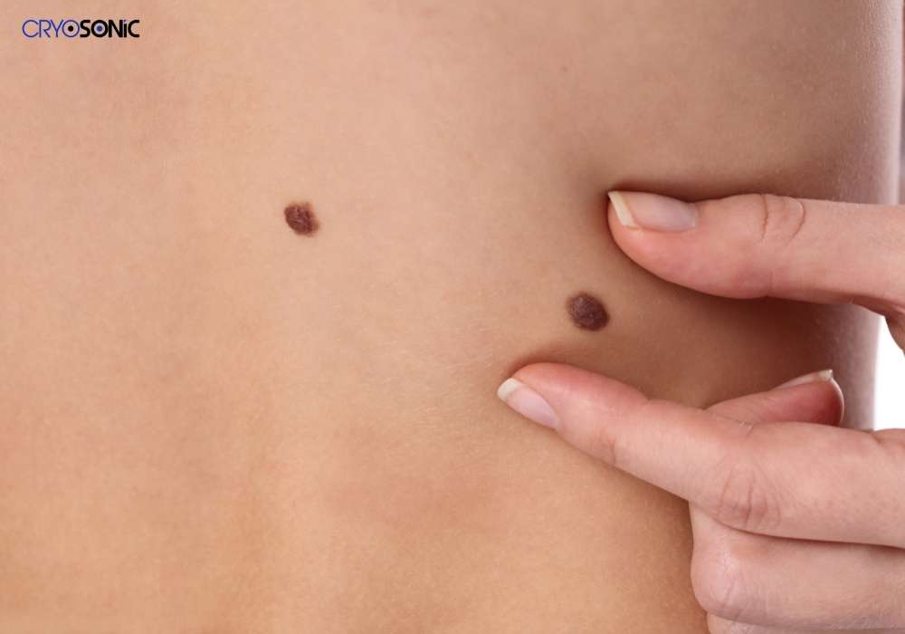 Infection Risk and Poor Aftercare Stoke-on-Trent
