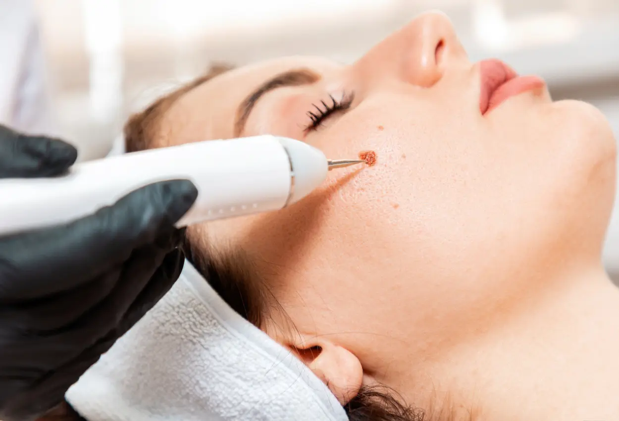 Frequently Asked Questions About Multiple Cryotherapy Treatments Stoke-on-Trent