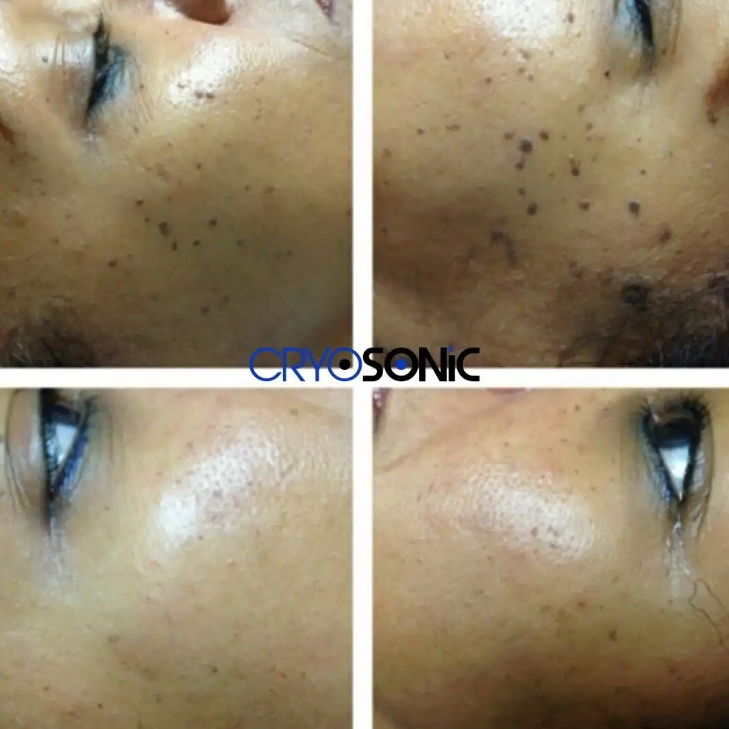 Why Skin Shows Pigmentation After Treatment Stoke-on-Trent