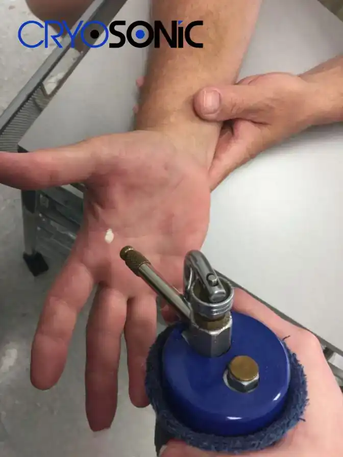 Temperature Differences: OTC vs Medical-Grade Cryotherapy Stoke-on-Trent